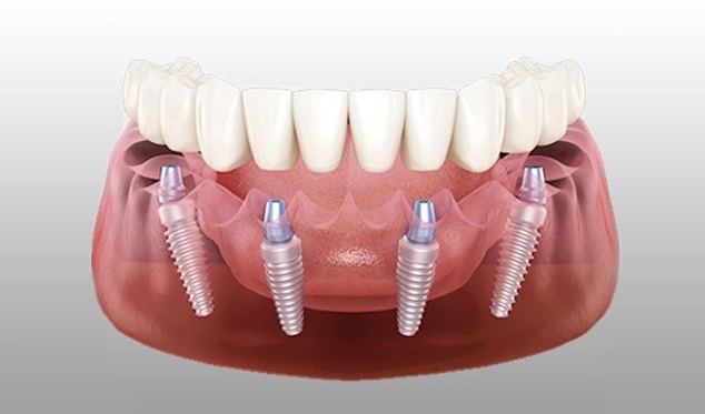 cheapest-country-for-all-on-4-dental-implants