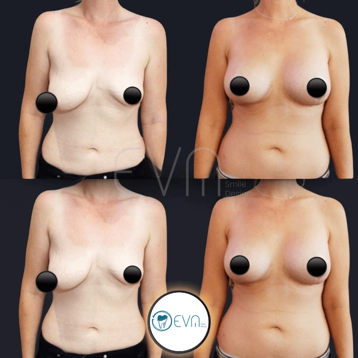 Lifting mammaire before and after gallery image 1