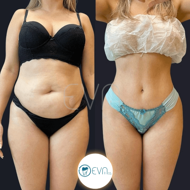 Liposuction vs Tummy Tuck in Turkey: Which Body Contouring Procedure Is Right for You?