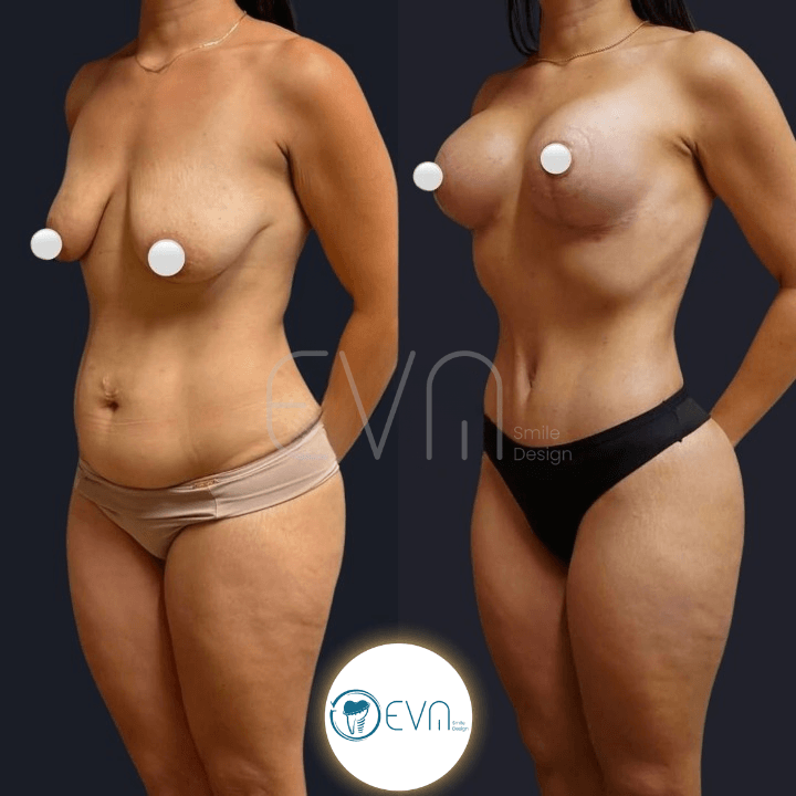 Breast Lift vs Breast Implants in Turkey: Which Option Creates a More Natural Result?
