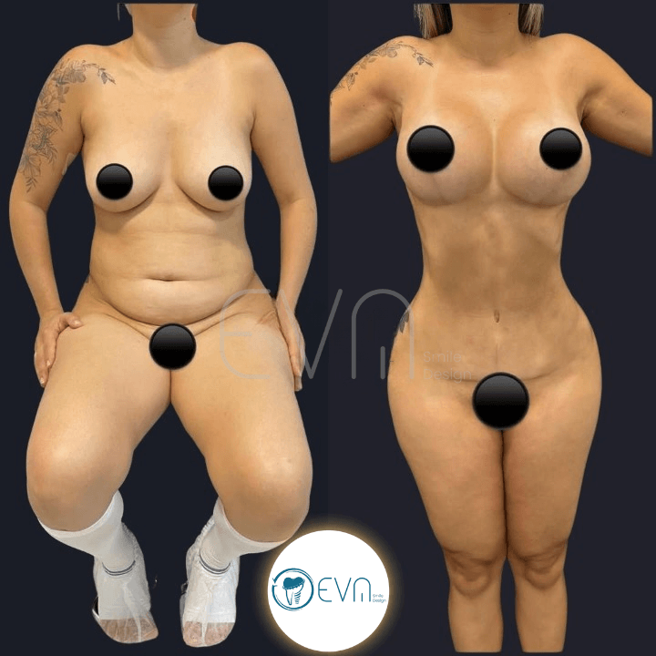 Mummy Makeover in Turkey: Procedures, Recovery, Safety and How Much Surgery Is Too Much?
