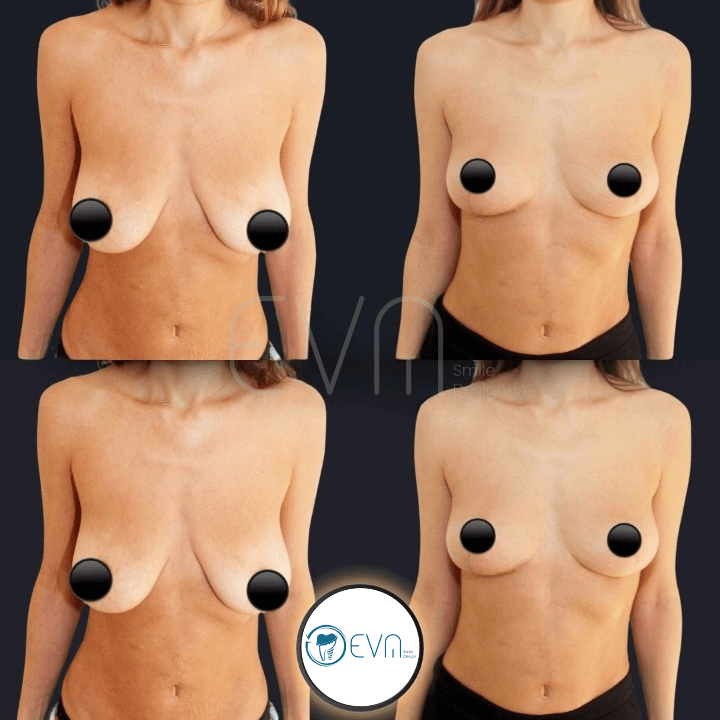 Lifting mammaire before and after gallery image 2