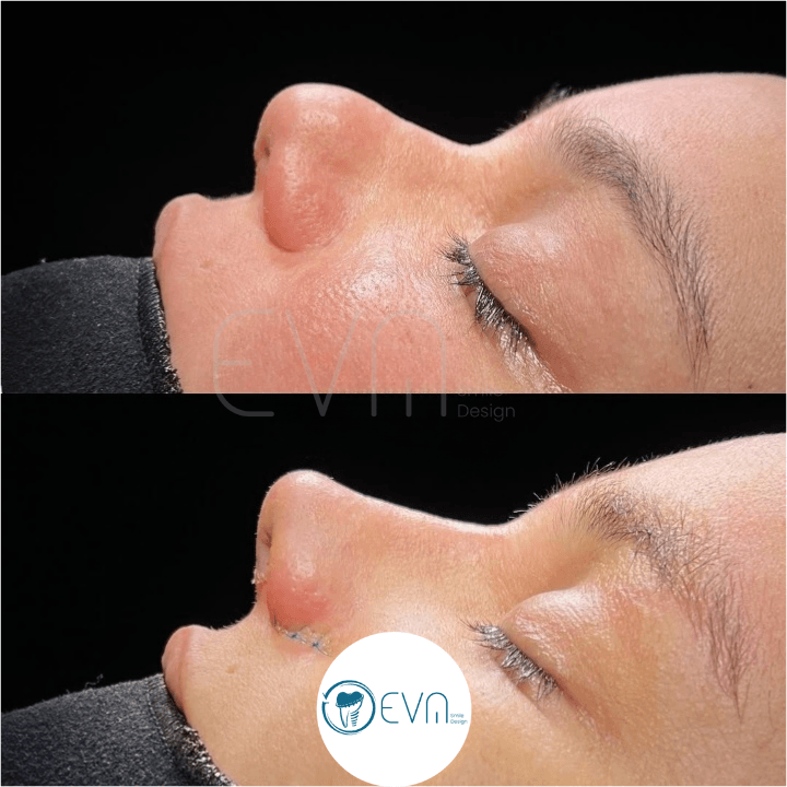 Rhinoplasty in Turkey: Cost, Recovery Timeline, Risks and Planning for International Patients