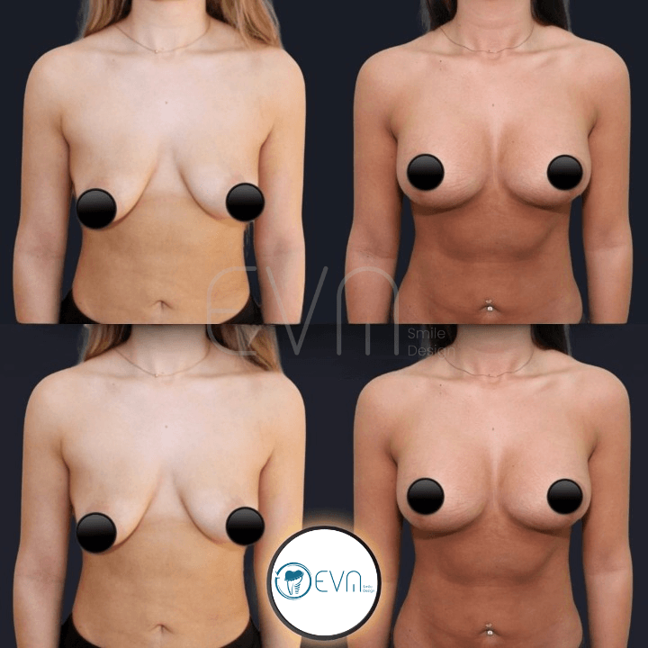 Lifting mammaire before and after gallery image 3