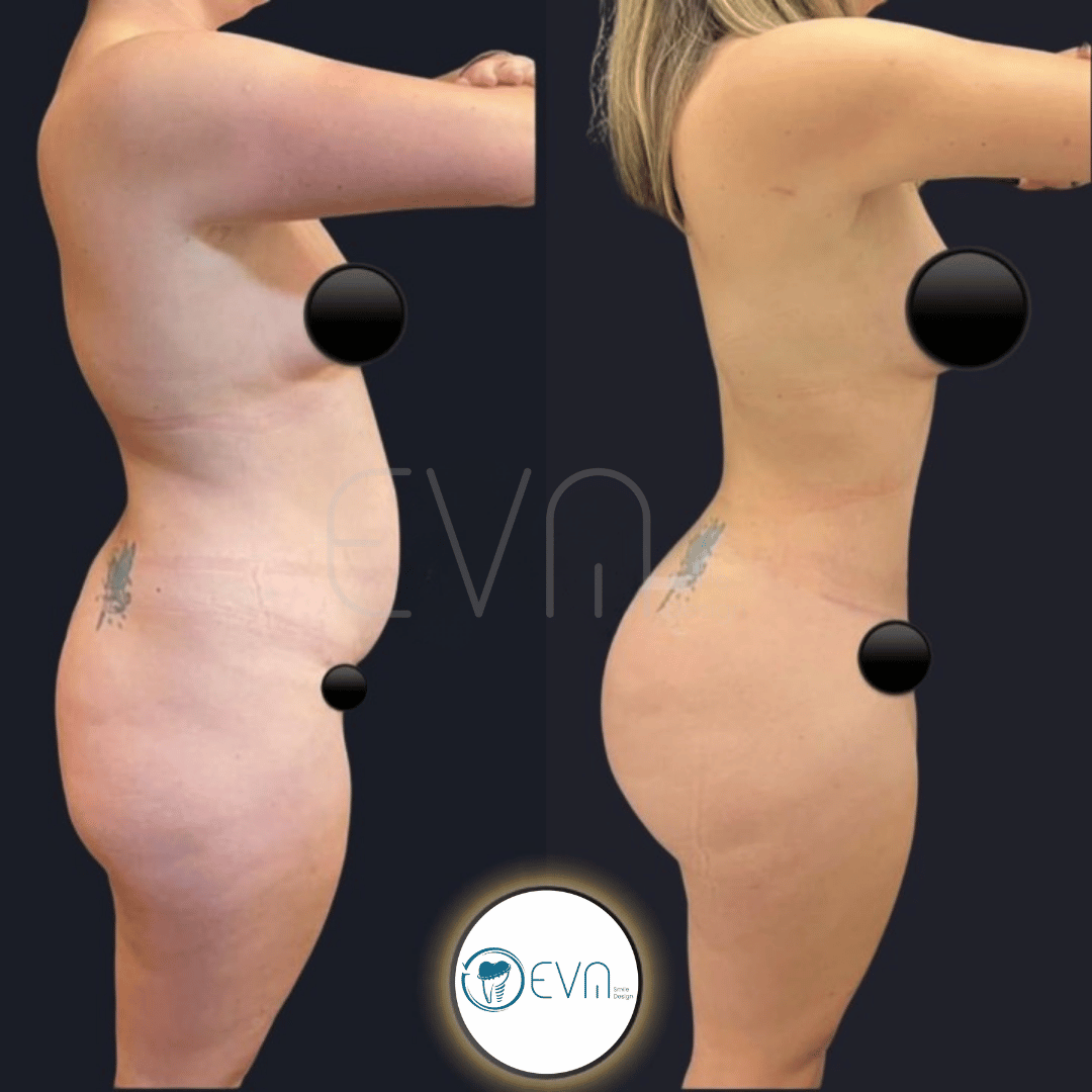 Tummy tuck before and after gallery image 2