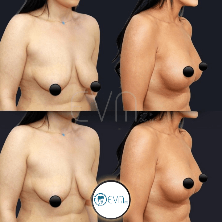 Lifting mammaire before and after gallery image 4