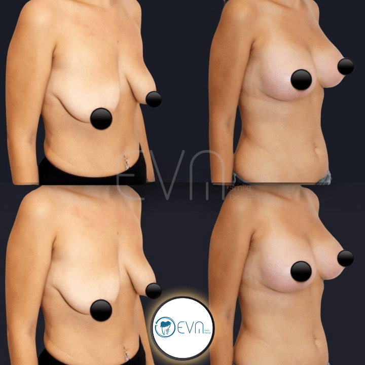 Lifting mammaire before and after gallery image 5