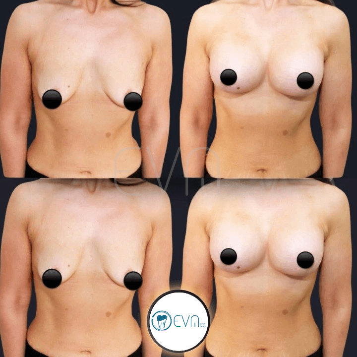 Lifting mammaire before and after gallery image 6