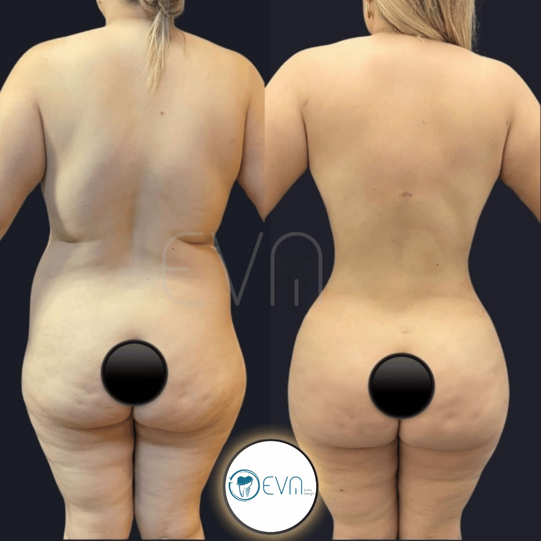 Tummy tuck before and after gallery image 1