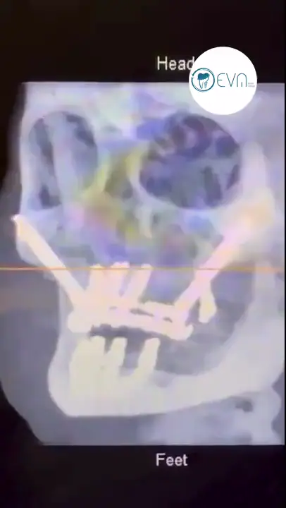 Couverture vidéo avant et après des implants dentaires de Mara