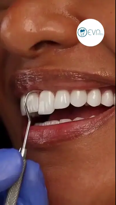 Dental veneers and crowns treatment planning illustration