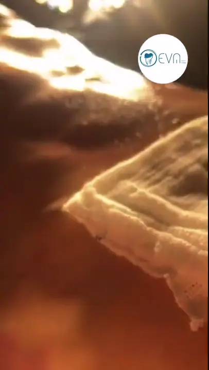 Abbey Liposuccion Vaser 4D in Turkey Before and After video cover