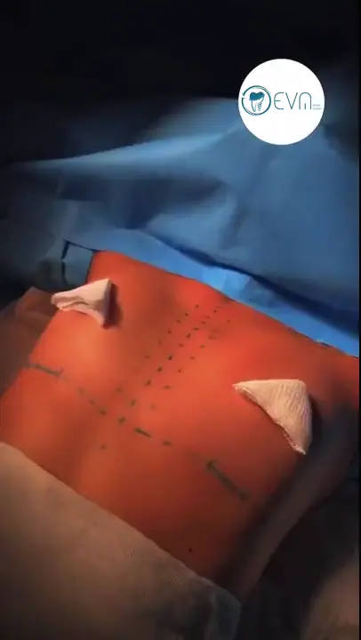 Abbigail Augmentation mammaire Before and After video cover