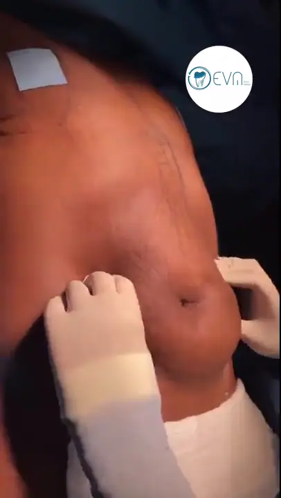 Abigayle Liposuccion in Turkey Before and After video cover