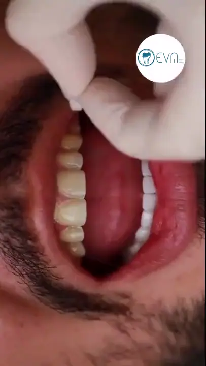 Adam Conception numérique du sourire in Turkey Before and After video cover