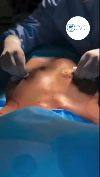 Adriana Lifting mammaire Before and After video cover