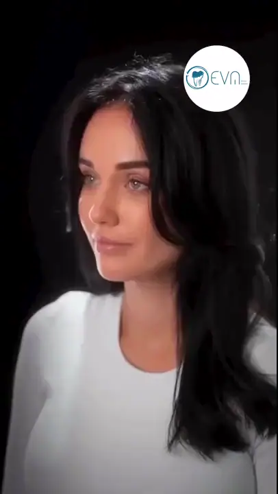 Adrianna Facettes laminées in Turkey Before and After video cover