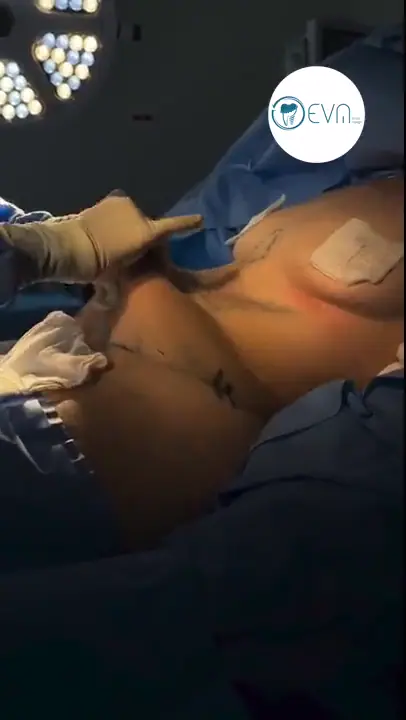 Abdominoplastie d’Aiyana avant et après video cover