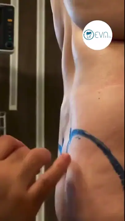 Abdominoplastie d’Alexa avant et après video cover