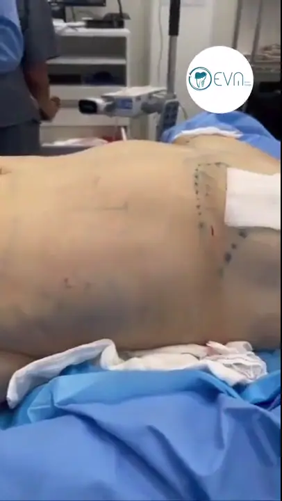 Abdominoplastie d’Alisa avant et après video cover