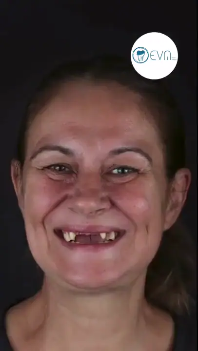 Couverture vidéo avant et après des implants dentaires de Alycia