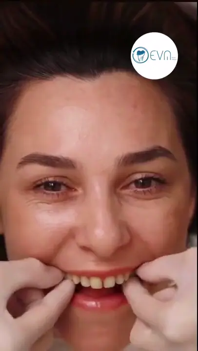 Hollywood Smile d’Alyssa en Turquie avant et après video cover