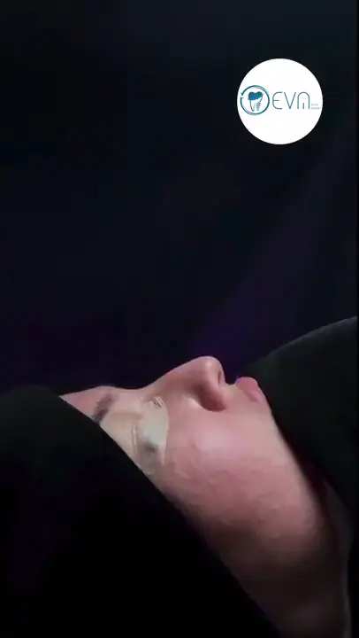 Image de couverture d’une vidéo de rhinoplastie