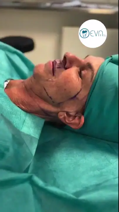 Annie Lifting du visage Before and After video cover