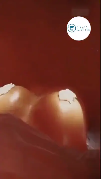 Avery Lifting mammaire in Turkey Before and After video cover