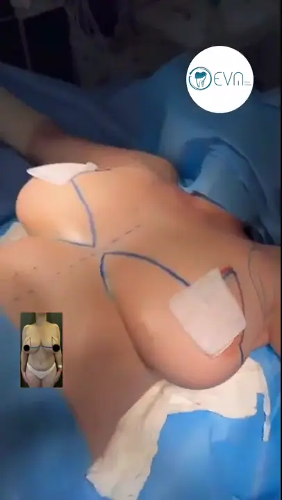 Brenda Lifting mammaire in Turkey Before and After video cover