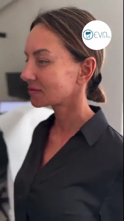 Carlie Lifting du visage Before and After video cover