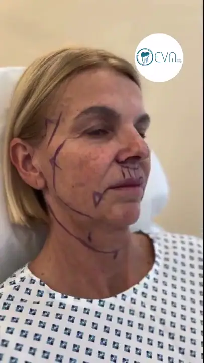 Fiona Lifting du visage Before and After video cover