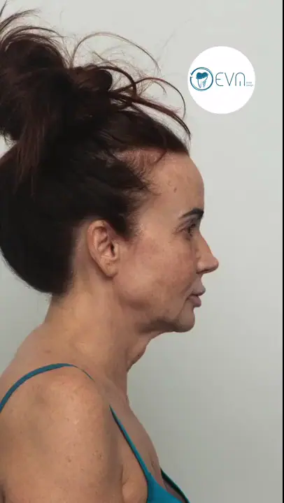 Francesca Lifting du visage Before and After video cover