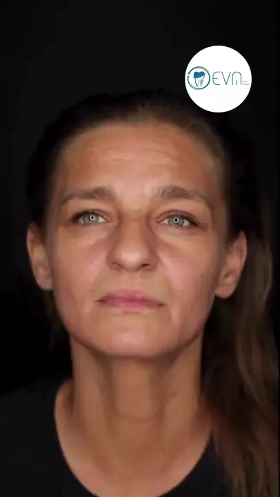 Couverture vidéo avant et après des implants dentaires de Hazel